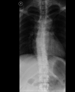 imaging_dg_scoliosis
