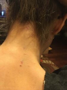 Closeup of left female’s shoulders and neck. Her hair is pulled up. There are several needle marks where they were put into her spine.